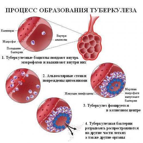 Первые признаки туберкулеза легких у женщин и мужчин