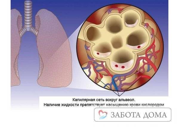 Пневмония у лежачих больных: причины, симптомы, лечение