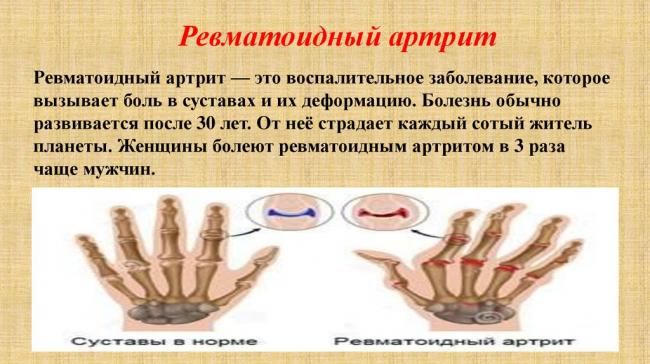 Остеоартроз: симптомы, лечение, причины, препараты