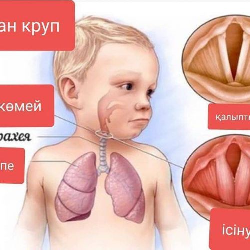 Ложный круп у детей – как определить и вылечить заболевание?
