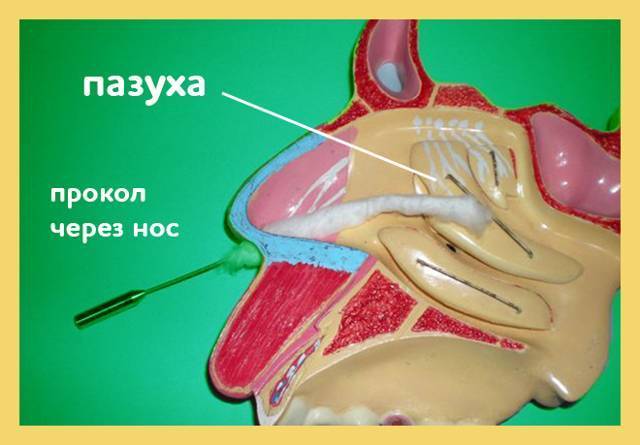 Можно ли вылечить гайморит, не прибегая к проколу?