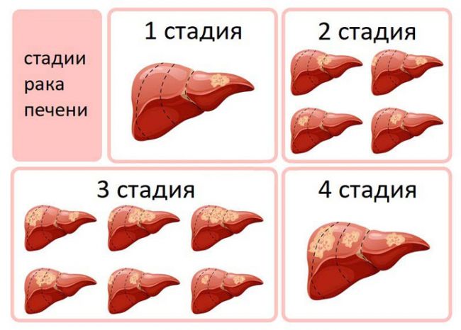 Доброкачественные опухоли печени. гемангиомы