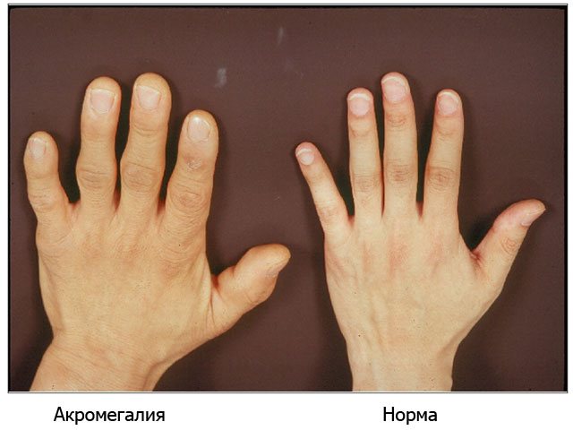 Питание при переломах