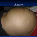 Что такое асцит печени: симптомы и лечение