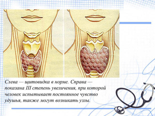 Психиатрические расстройства: щитовидная железа может быть причиной