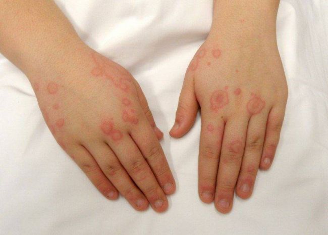 Аллергические прыщи на лице: причины, лечение, как быстро избавиться от аллергии в виде прыщей