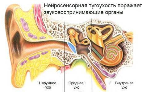 Что такое сенсоневральная тугоухость: симптомы и лечение