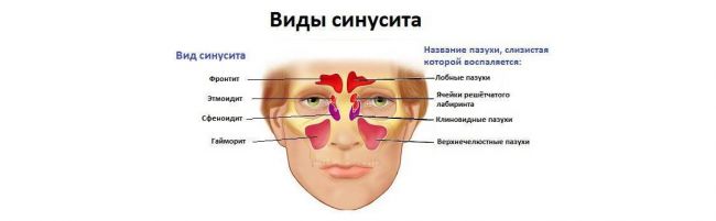 Лечение хронического гайморита у взрослых