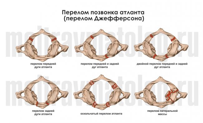 Компрессионный перелом позвоночника: причины, лечение, последствия