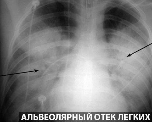 Рентгеновское исследование при пневмонии. симптомы, признаки, описание рентгена при пневмонии