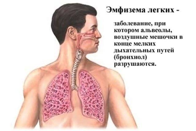 Обструктивный бронхит у грудничков
