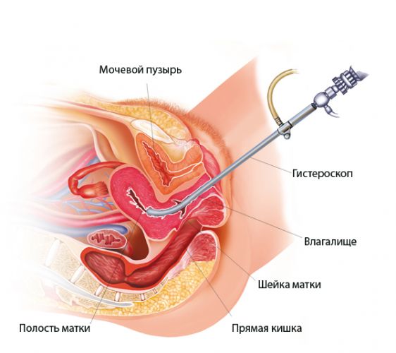 Полип эндометрия в матке