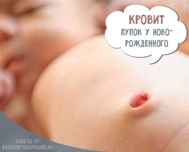 Кровит пупок у новорожденного ребенка — причины и что делать