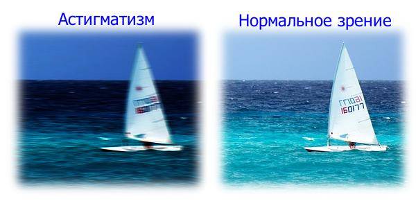 Что такое близорукий астигматизм? лечение простого и сложного близорукого астигматизма в fedorovmedcenter
