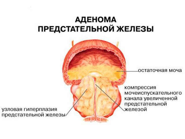 Простатилен ампулы