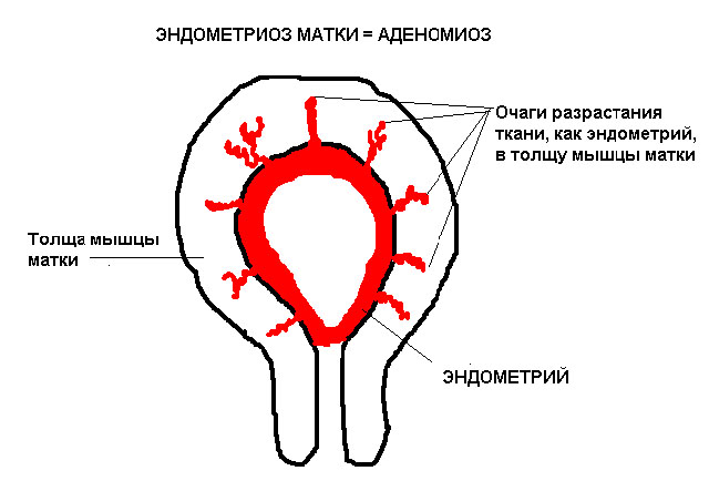 Является ли аденомиоз матки раком: описание заболевания и злокачественные образования