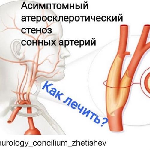 Расслоение сонной артерии: патофизиология, причины, диагностика, лечение