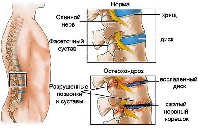 Боль в пояснице у мужчин — причины, полное описание возможных проблем