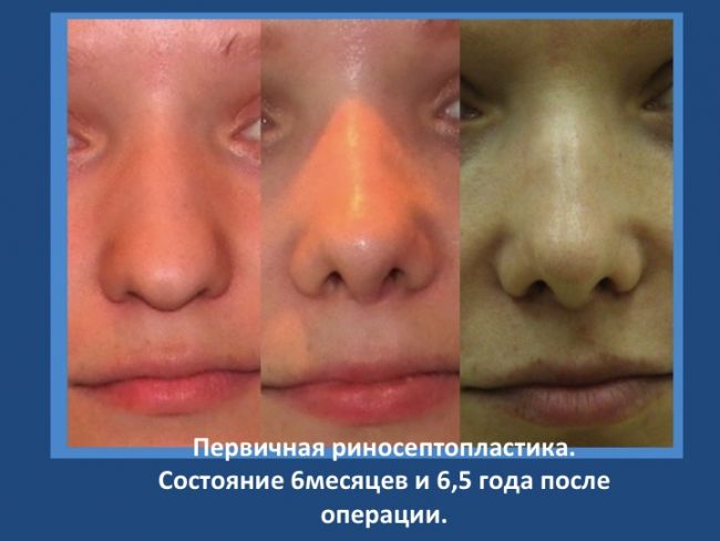 Риносептопластика: суть и виды операции, когда показана, ход, восстановление после