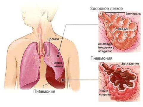 Как понять что у тебя пневмония как узнать воспаление легких