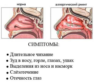 Аллергический ринит: причины, симптомы и лечение у взрослых