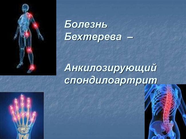 Анкилозирующий спондилоартрит (болезнь бехтерева)