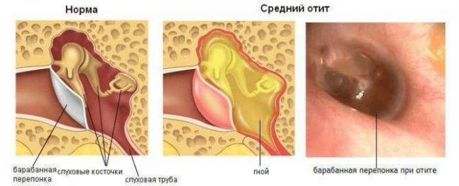 Как долго лечится отит у взрослых?
