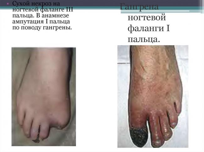 Еще одно последствие курения — болезнь бюргера. проявления, диагностика и лечение патологии