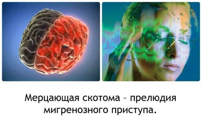 Скотома глаза: что это такое