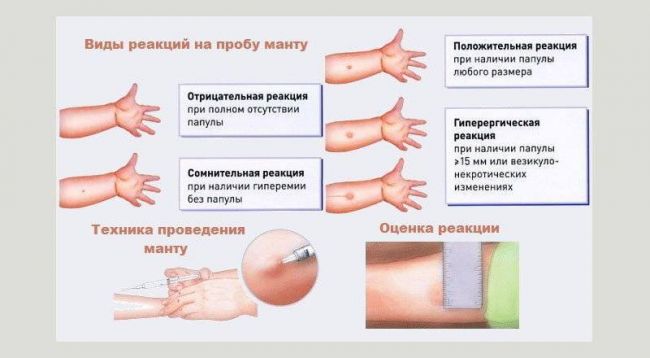 Манту прививка для чего делают и нужна ли ребенку