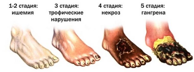 Облитерирующий эндартериит - лечение рекомендует профессор