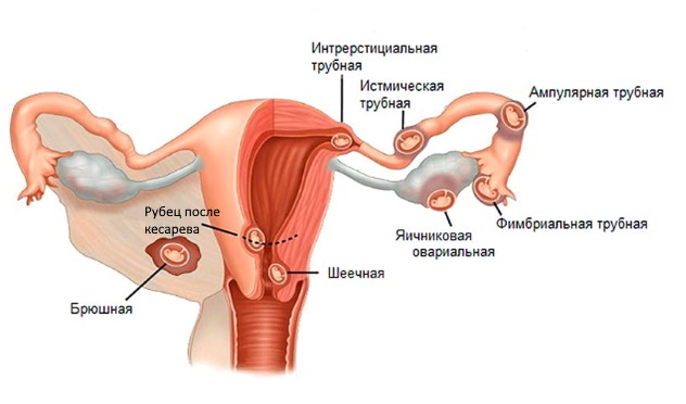 Внематочная беременность на ранних сроках