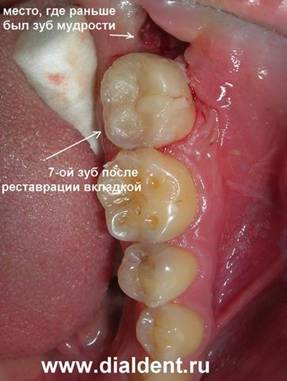 Как происходит удаление зуба мудрости