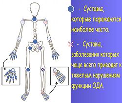 Что нельзя при остеоартрозе