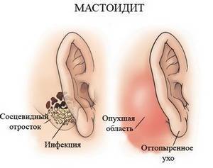 Мастоидит