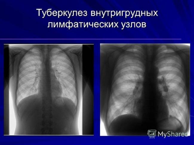 Туберкулёз внутригрудных лимфатических узлов: описание заболевания и методы борьбы с ним