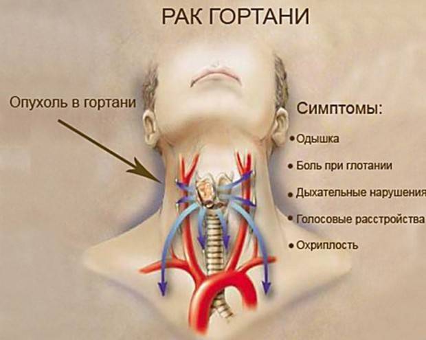Болезни горла и гортани – причины, симптомы, лечение и профилактика