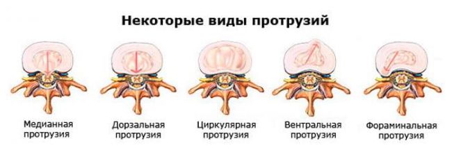 Симптомы и лечение грыжи позвоночника