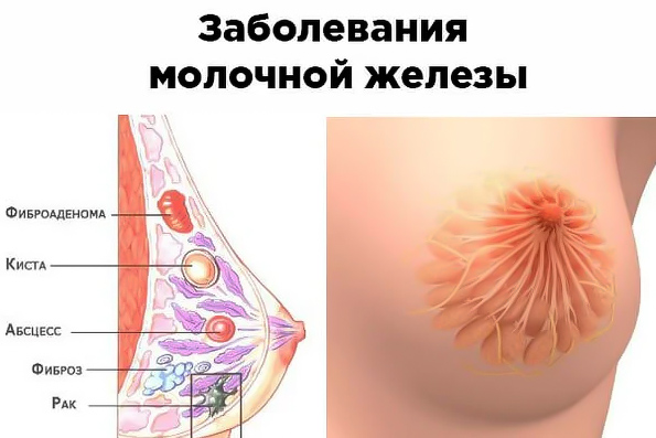 Фиброаденома молочной железы