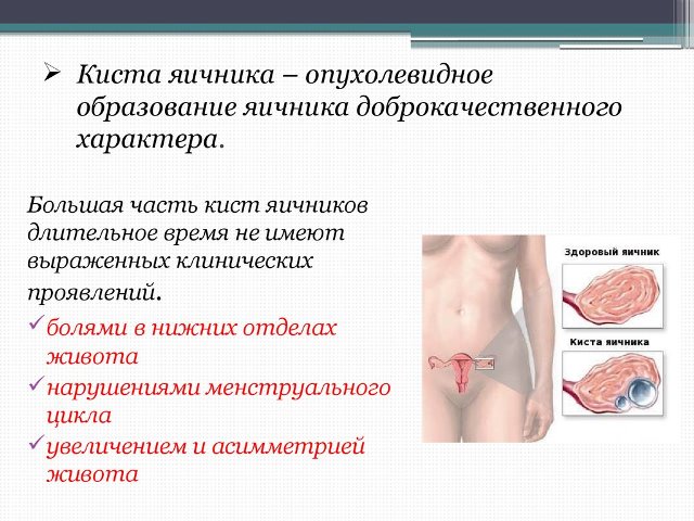 Функциональная киста яичника: симптомы и лечение