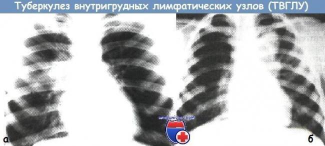 Туберкулез у детей