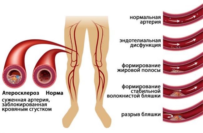 Симптомы и лечение облитерирующего эндартериита сосудов ног