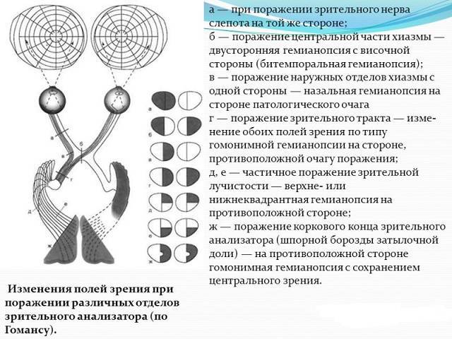 Лечение гемианопсии после инсульта