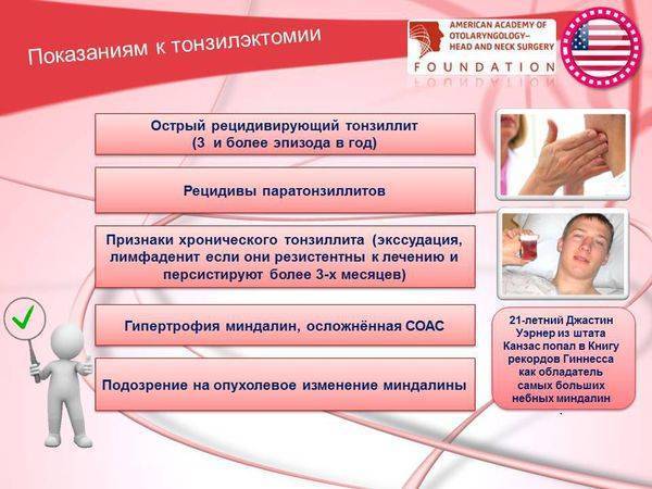 Причины возникновения и лечение хронического декомпенсированного тонзиллита