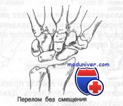 Факторы возникновения перелома лучевой кости