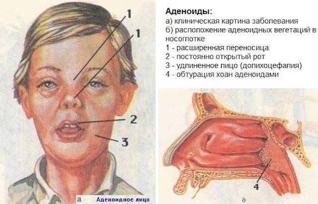 Симптомы и лечение аденоидита у детей: хронический, гнойный, острый