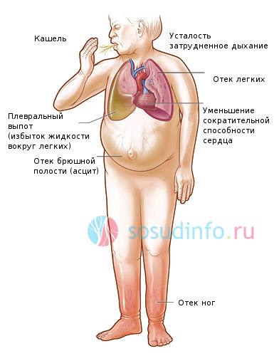 Если задыхаешься при сердечной недостаточности