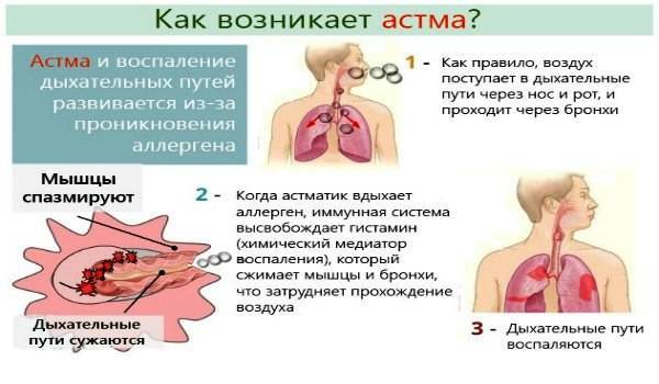 Одышка при бронхиальной астме: причины появления и профилактика