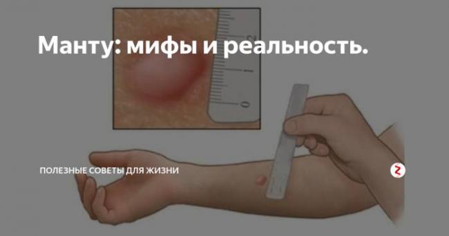 Противопоказания к проведению пробы манту