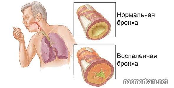 Почему идет кровь из горла, что делать и насколько это серьезно?